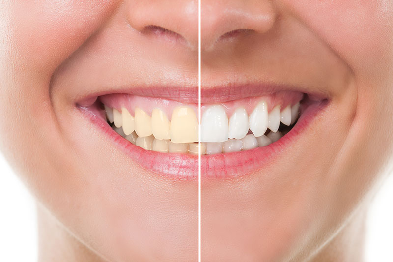 Teeth Whitening in Greenville